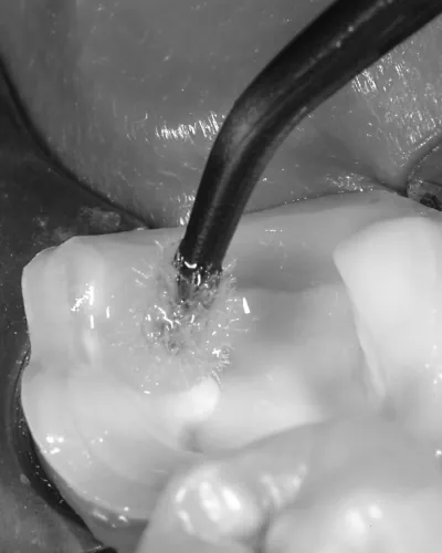 Adhesive being applied to a prepared tooth