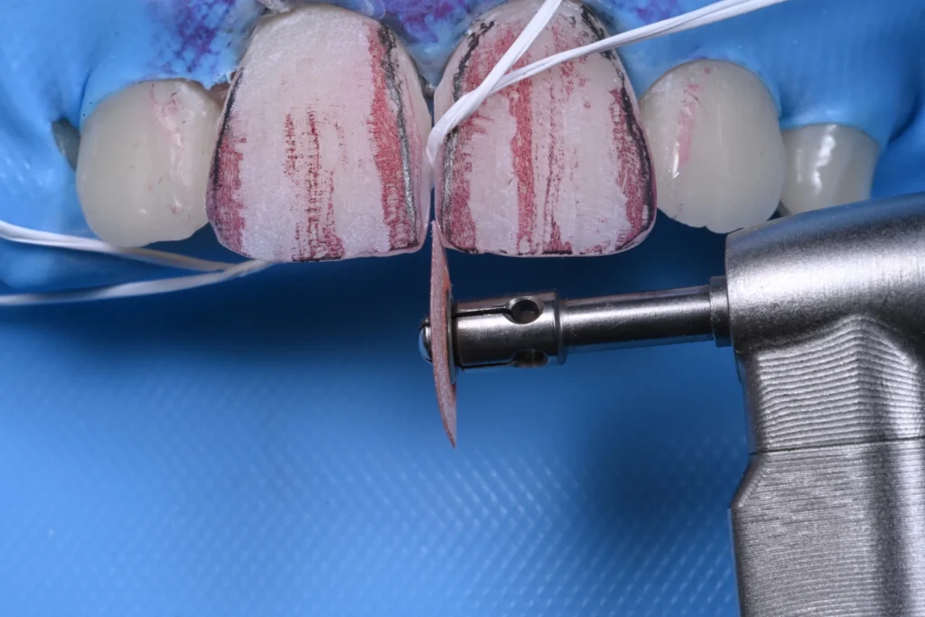 1 ADVANCED COMPOSITE VENEERS magne education beverly hills dental lab