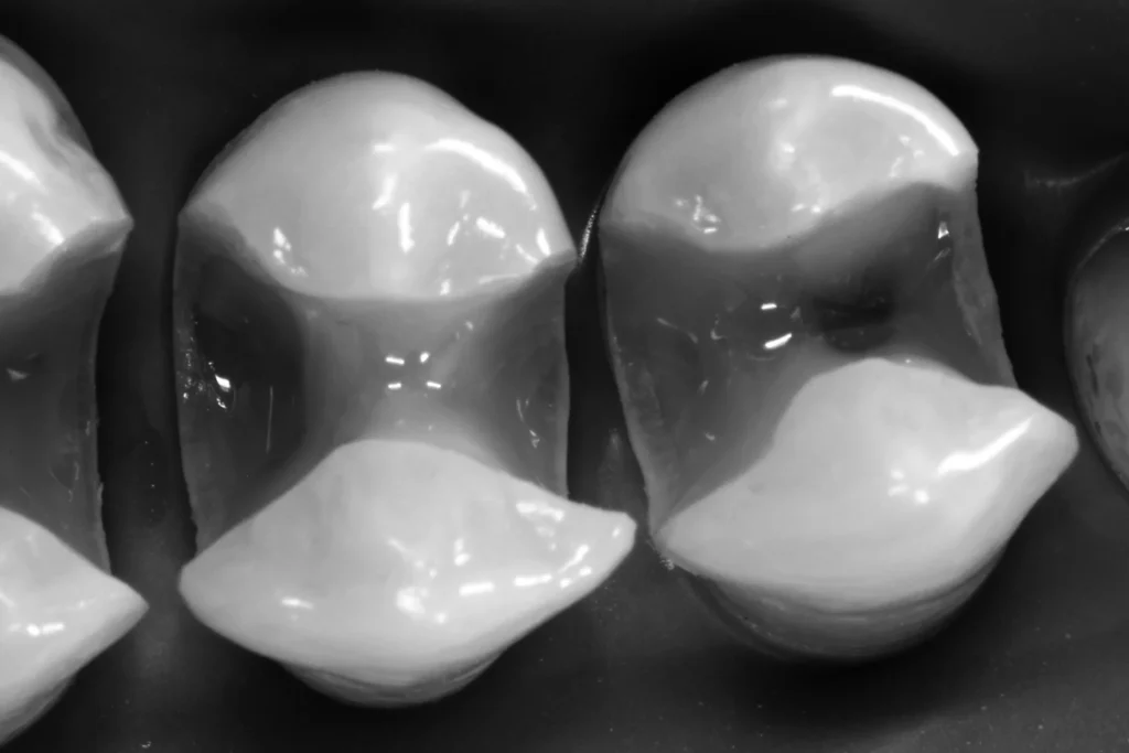 1 ADVANCED INLAY ONLAY magne education beverly hills dental lab