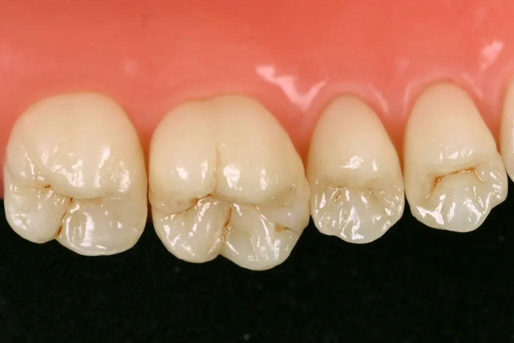 1 POSTERIOR COMPOSITE RESTORATIONS magne education beverly hills dental lab