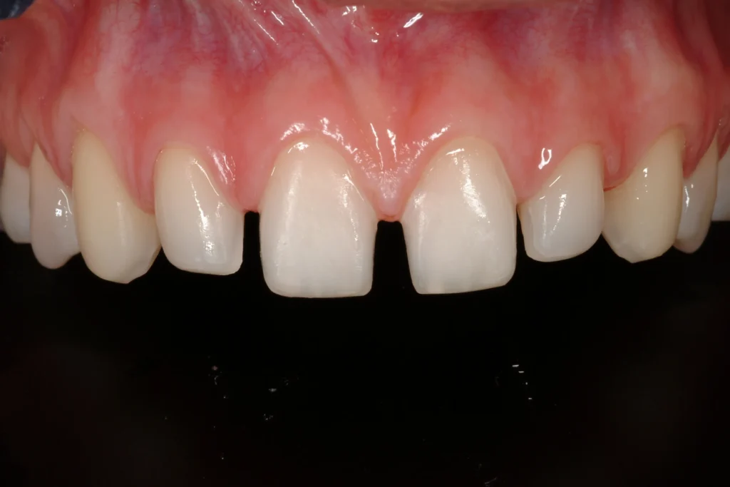 1 THE ULTIMATE VENEER magne education beverly hills dental lab