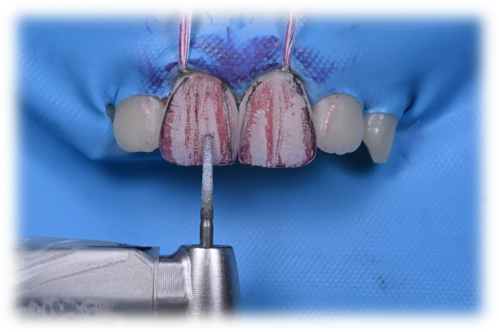 2 ADVANCED COMPOSITE VENEERS magne education beverly hills dental lab