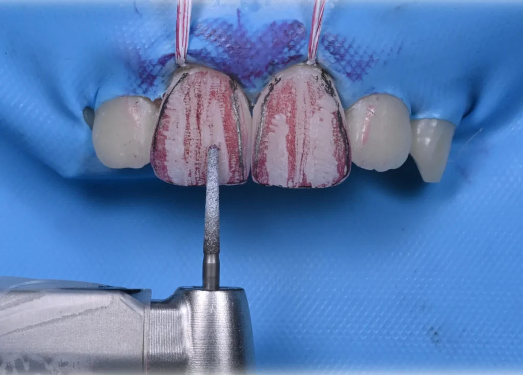 2 ADVANCED COMPOSITE VENEERS magne education beverly hills dental lab(1)