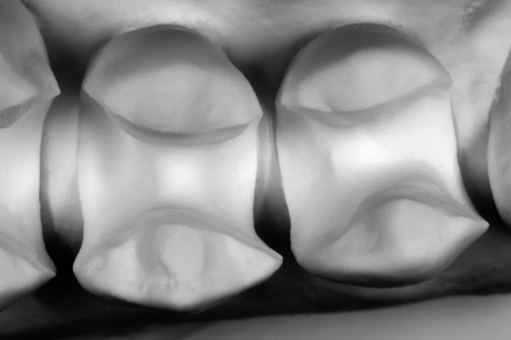 2 ADVANCED INLAY ONLAY magne education beverly hills dental lab