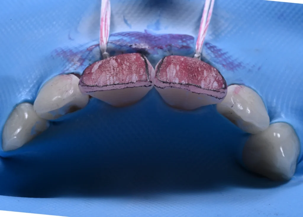 3 ADVANCED COMPOSITE VENEERS magne education beverly hills dental lab