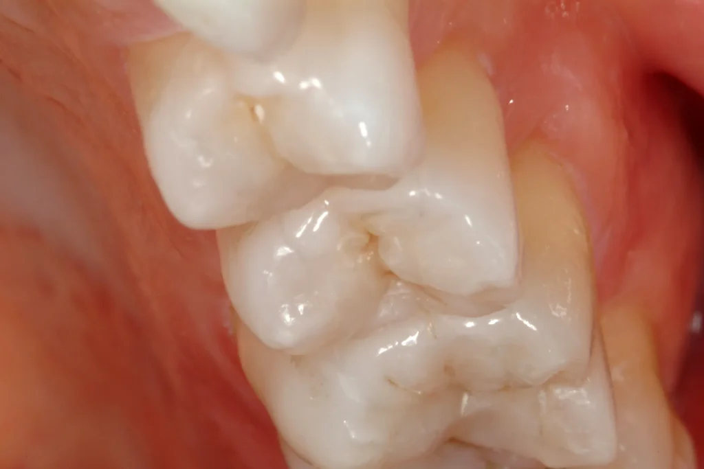 3 ADVANCED INLAY ONLAY magne education beverly hills dental lab