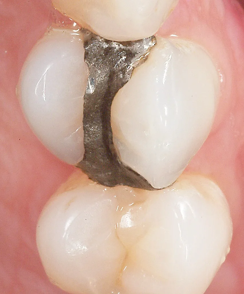 3 POSTERIOR COMPOSITE RESTORATIONS magne education beverly hills dental lab