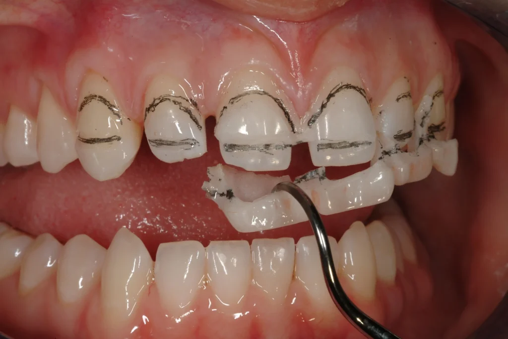 3 THE ULTIMATE VENEER magne education beverly hills dental lab