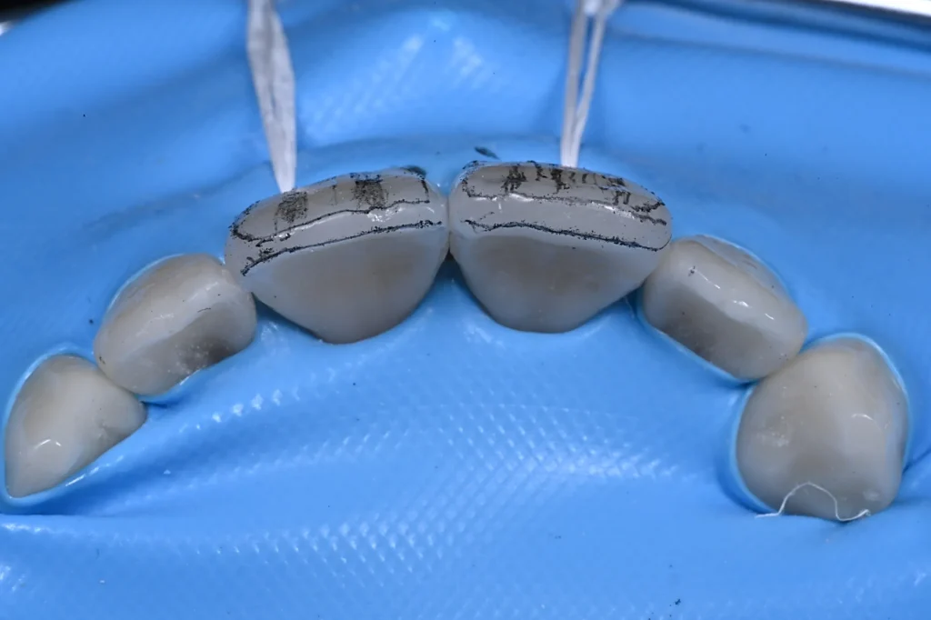 4 ADVANCED COMPOSITE VENEERS magne education beverly hills dental lab