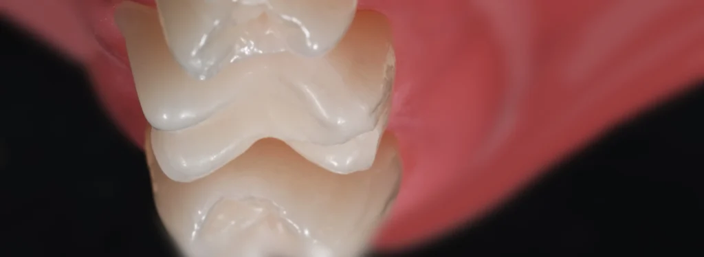 4 ADVANCED INLAY ONLAY magne education beverly hills dental lab
