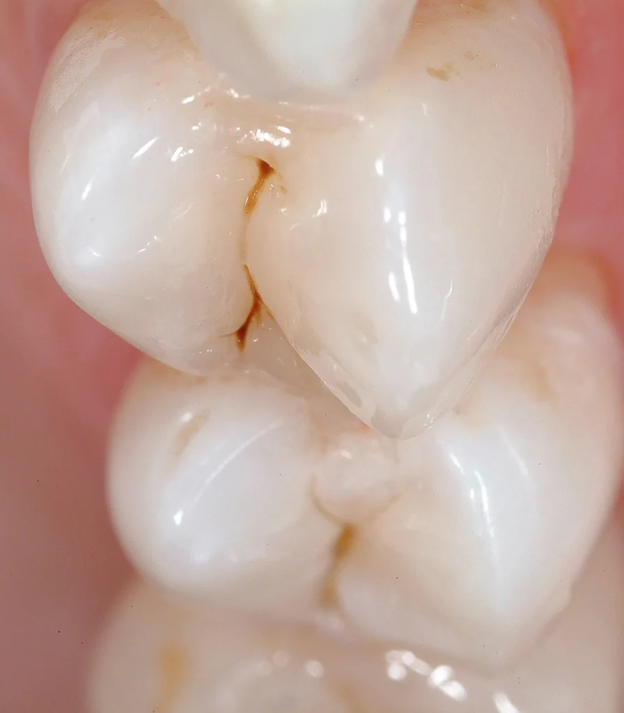 4 POSTERIOR COMPOSITE RESTORATIONS magne education beverly hills dental lab