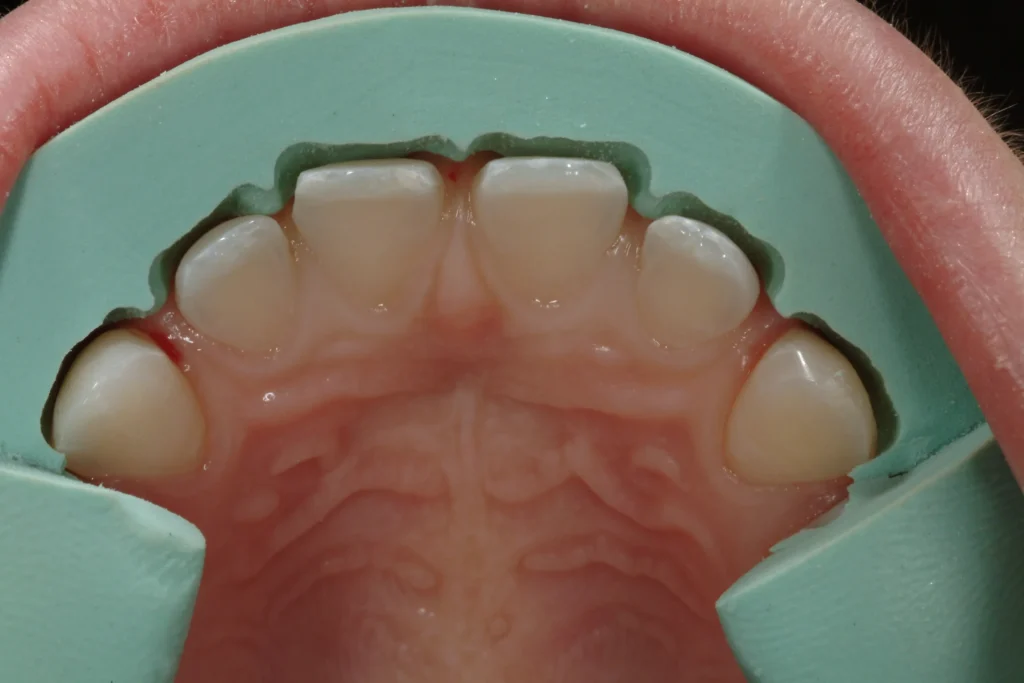 4 THE ULTIMATE VENEER magne education beverly hills dental lab