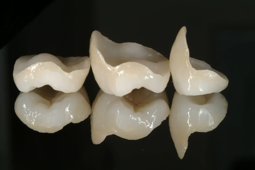 5 ADVANCED INLAY ONLAY magne education beverly hills dental lab