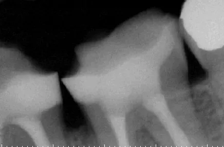 5 POSTERIOR COMPOSITE RESTORATIONS magne education beverly hills dental lab