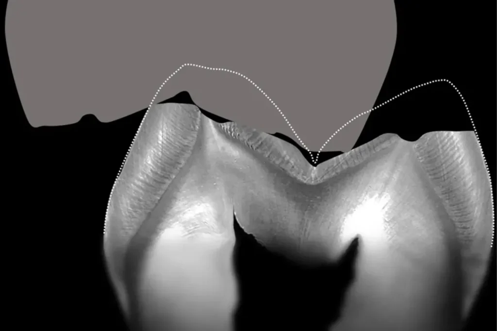 extrawear 1 magne education expert beverly hills dental lab