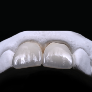 CADplus Microlayering of E max Veneers Part 2