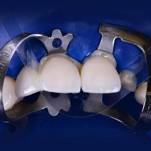 Adhesive Cementation Step by Step