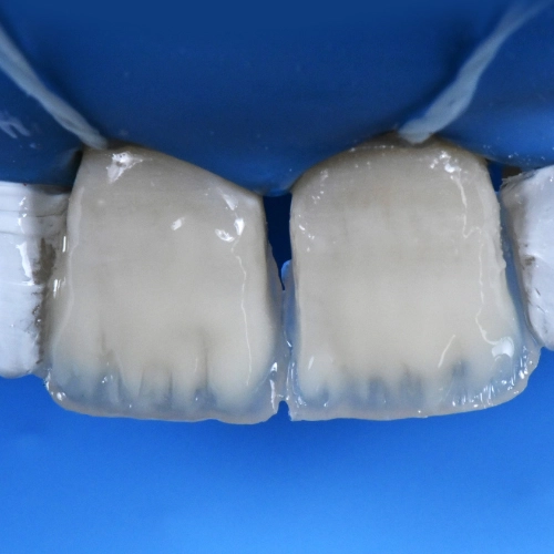 Composite Resin Layering Principles