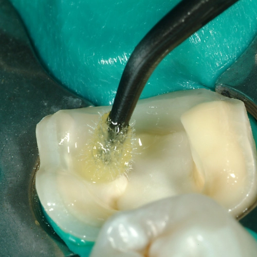 Enamel Dentin Adhesives